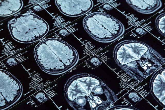 Cooperação internacional entre universidades acelera a busca por tratamentos de Alzheimer, epilepsia e leishmaniose 